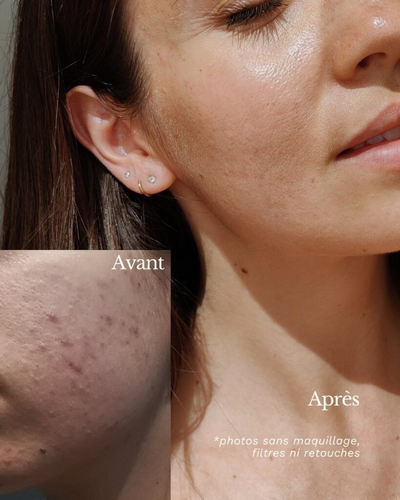 Illustration-acne-adulte-psychosomatique-peau-avant-apres-Aurathera-2025 Avant-après acné adulte psychosomatique